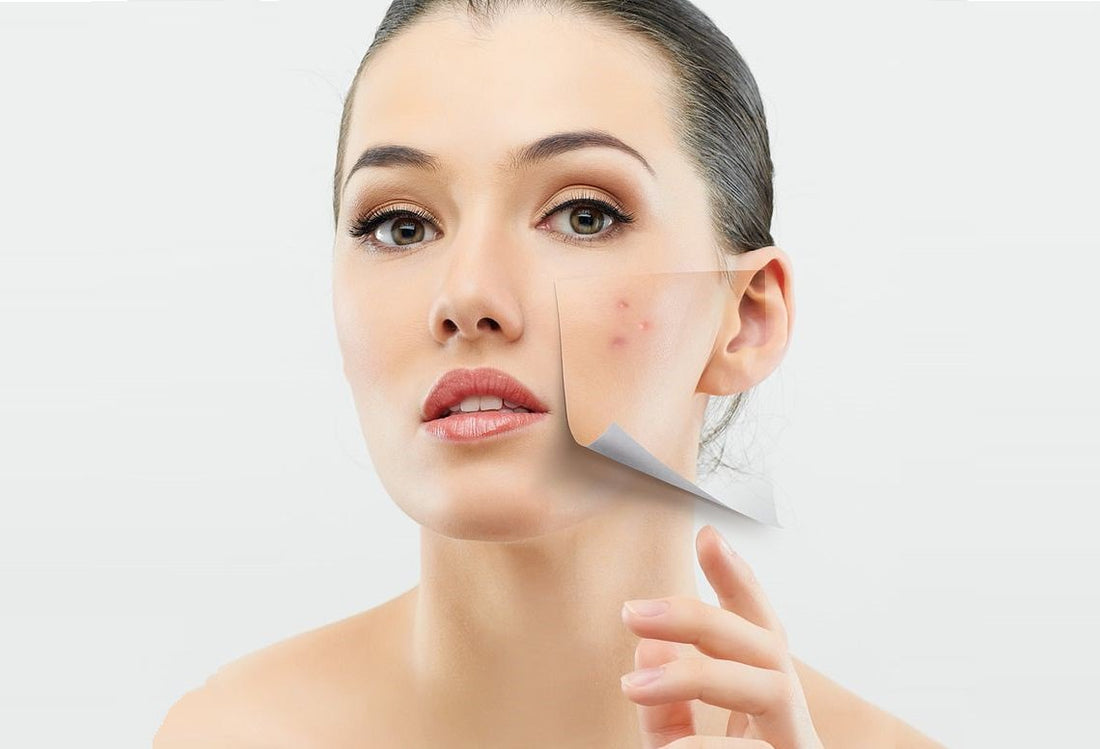 Best Microneedling Devices for Acne Scars: What to Look For