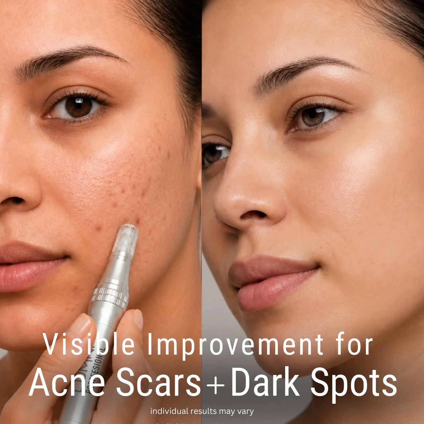 LUMNi Microneedling Kit for Acne Scars & Dark Spots