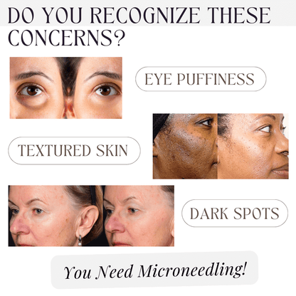 Collagen MicroNeedling Starter Kit